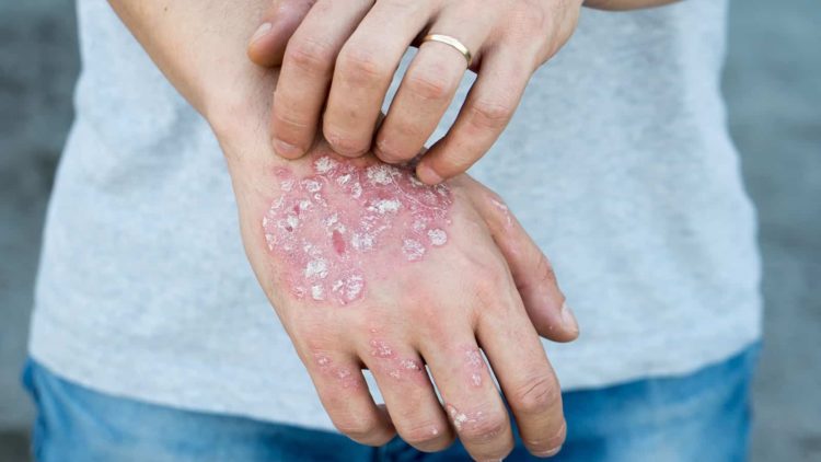 Come curare l'eczema?